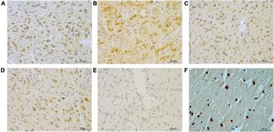 SCG3 Protein Expression in Glioma Associates With less Malignancy and Favorable Clinical Outcomes